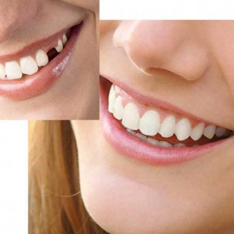 HiSmile Zahnreparatur KIT | Die schönsten Zähne in wenigen Minuten!